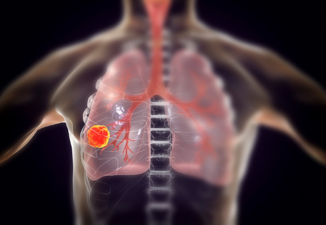 Immagine di un cancro al polmone.